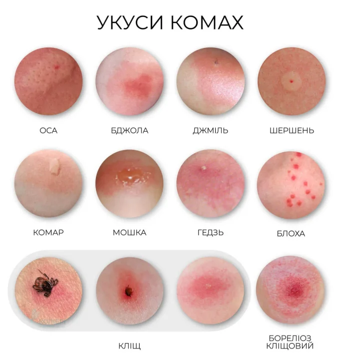 як виглядають укуси комах